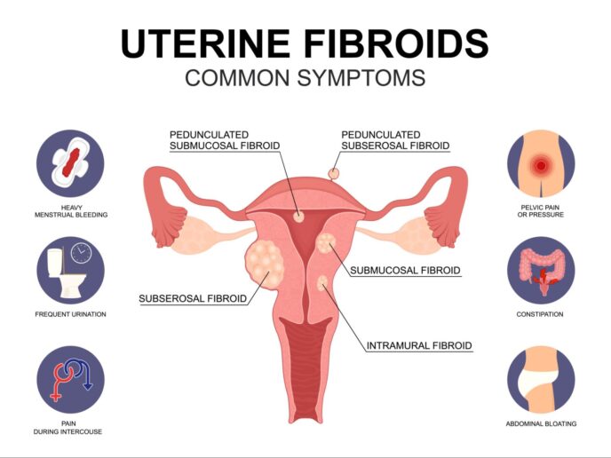 Diagram showing uterine fibroids growing inside and around the uterus
