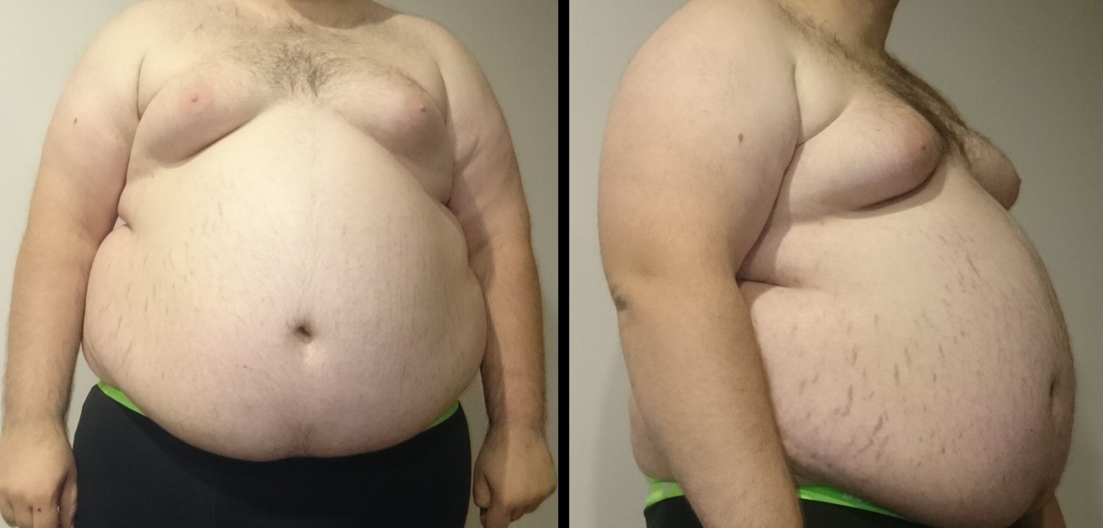 Obesity( Big Belly)