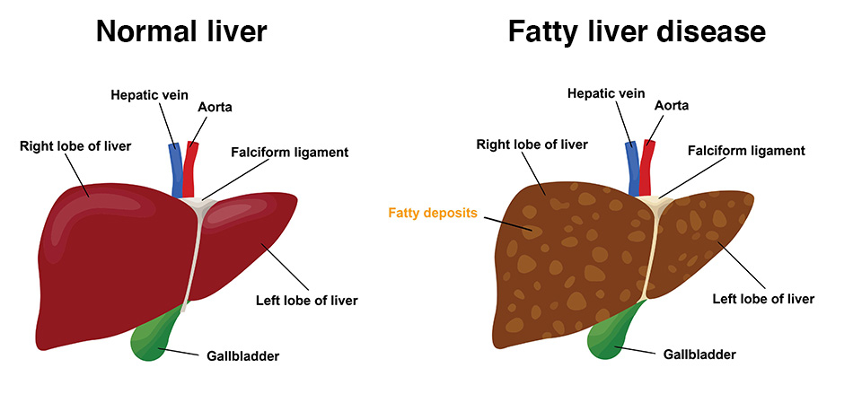 intermittent fasting and fatty liver