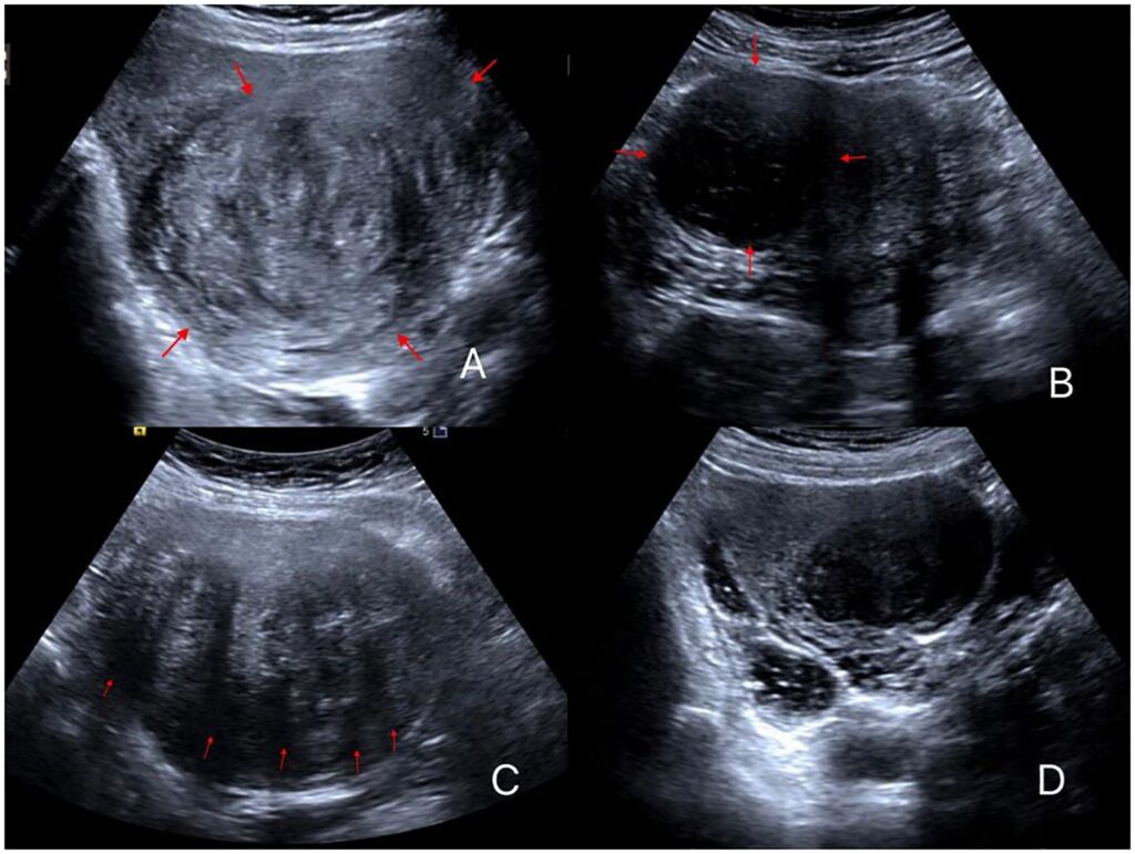 Ultrasound scan used to diagnose uterine fibroids