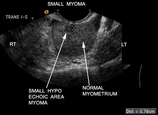 Ultrasound scan used to diagnose uterine fibroids