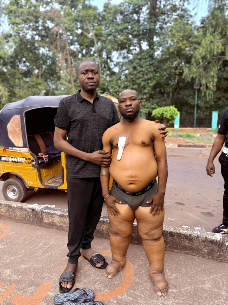 early signs of kidney disease